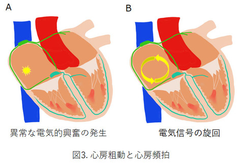 図3. 心房粗動と心房頻拍