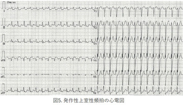 図5. 発作性上室性頻拍の心電図 