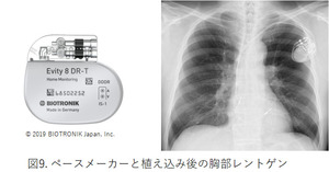 図9. ペースメーカーと植え込み後の胸部レントゲン